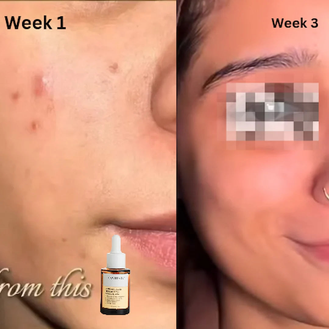 Customer before and after results using COVERAGE Azelaic Acid 10% Serum for acne and dark spots in Pakistan