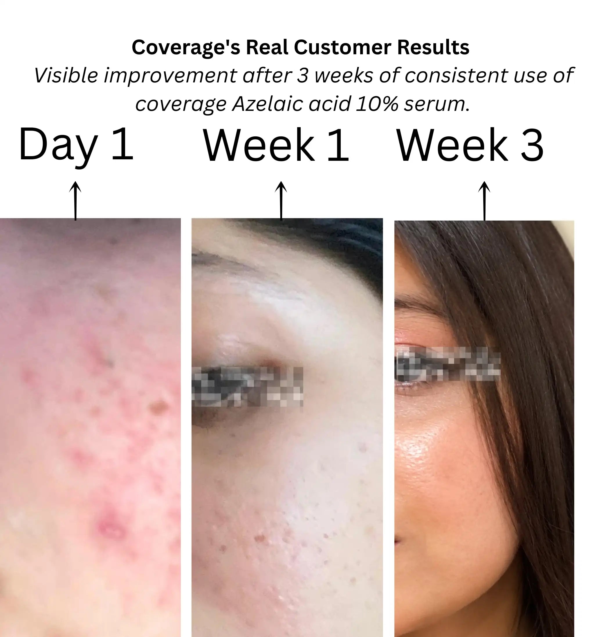 COVERAGE Azelaic Acid 10% Serum real customer results, Day 1 to Week 3 visible improvement