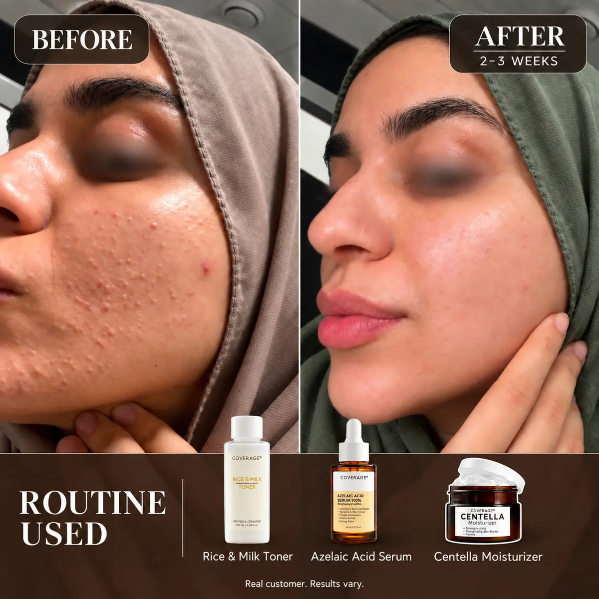Real customer before and after 2-3 weeks using COVERAGE Rice & Milk Toner, Azelaic Acid Serum and Centella Moisturizer on acne-prone, textured skin in Pakistan